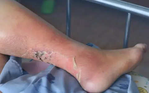 Gamba con edema e ulcere alle caviglie, la pelle è arrossata e screpolata, con aree di necrosi.