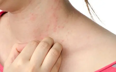 Pelle arrossata e irritata sul collo, con piccole pustole rosse. Una mano si gratta, sintomo di sudore e prurito.