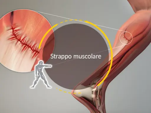 Illustrazione anatomica di uno strappo muscolare, con ingrandimento che mostra la sutura di una lesione muscolare.