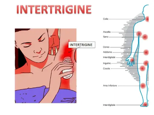 Intertrigine sotto il seno: rimedi della nonna per il rossore. Illustrazione mostra zone colpite da intertrigine.