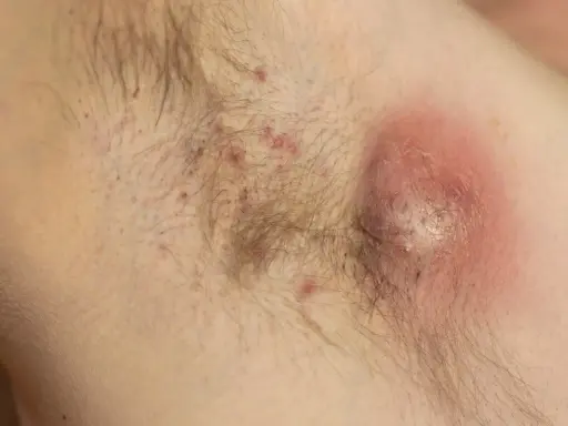 Arrossamento sotto le ascelle con pustole e un grosso ascesso infiammato.
