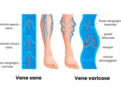 Illustrazione che mostra vene sane e vene varicose, evidenziando i problemi di insufficienza venosa gambe rimedi.