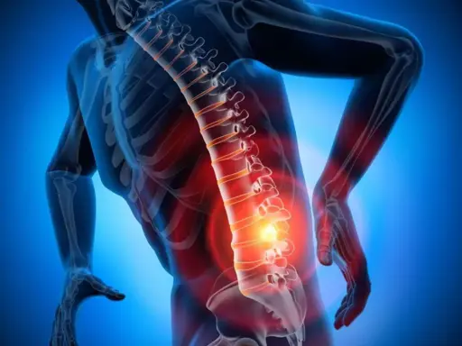 Schiena umana con colonna vertebrale evidenziata in rosso, indicando dolore e possibili ernia lombare con sintomi neurologici.