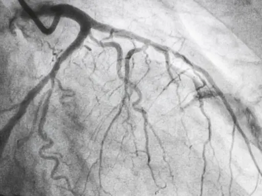 Immagine radiografica del cuore, mostrando le arterie coronarie dopo una coronarografia. Un passo importante nella convalescenza.