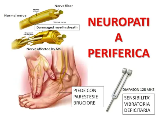 Illustrazione di neuropatia periferica con sintomi come parestesie e bruciore al piede, e diapason per testare la sensibilità vibratoria.