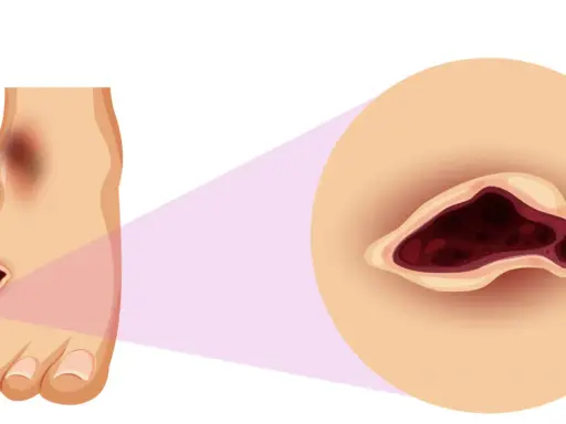 Ingrandimento di un piede con lesioni scure e profonde, che evidenzia la necessità di chi cura i piedi per trattare queste ferite.