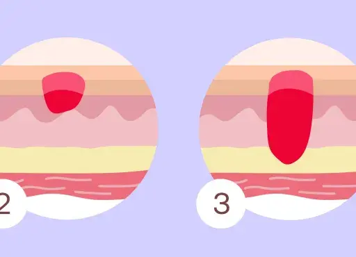 Illustrazione delle fasi di peggioramento delle piaghe da decubito, che sono dolorose. Danno superficiale a lesione profonda.