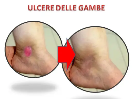 Prima e dopo: ulcere alle gambe che perdono acqua, ora in guarigione.