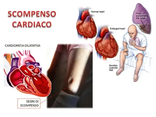 Illustrazione che mostra un cuore normale e ingrossato, un paziente con sintomi di scompenso cardiaco e fluidi polmonari. Lo scompenso cardiaco può regredire con cure adeguate.