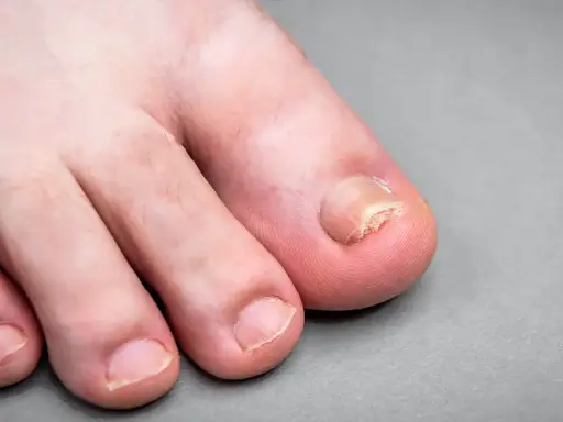Unghia del piede affetta da onicogrifosi, ispessita e deformata. Scopri come curarla per ritrovare piedi sani.