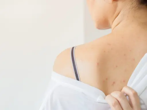 Schiena con eruzioni cutanee rosse, possibili segni di dermatite da sudore. Si cercano rimedi per alleviare il prurito e l'irritazione.