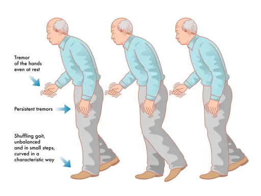 Uomo con tremori alle mani e andatura incerta, sintomi del parkinson. La difficoltà a parlare è un altro sintomo comune.