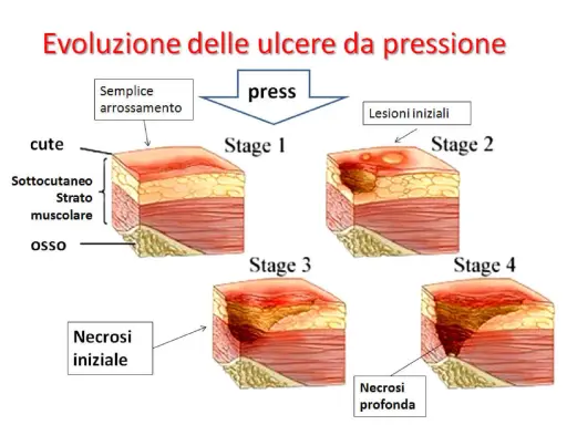 Evoluzione delle piaghe da decubito: da semplice arrossamento a necrosi profonda, mostrando le varie fasi di formazione.