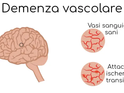 Illustrazione del cervello con un cerchio che indica un'area interessata da vasculopatia cerebrale cronica nell'anziano. Confronto tra vasi sanguigni sani e quelli colpiti da attacchi ischemici transitori.