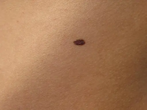 Un neo scuro sulla pelle, un piccolo punto che potrebbe nascondere insidie nei pericolosi.