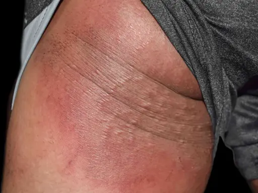 Arrossamento e piccole vescicole sulla pelle, indicative di dermatite sedere adulto.