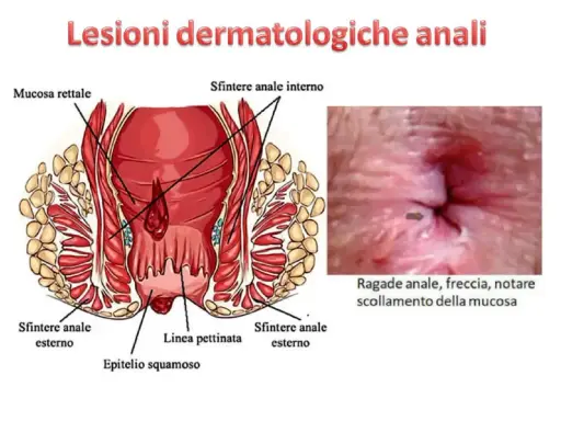 Illustrazione anatomica dell'ano e immagine di una ragade anale, che può causare dermatite perianale.