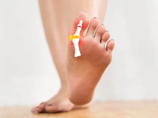 Piede con evidenziato un lieve alluce valgo, con schema osseo e zone rosse di infiammazione.