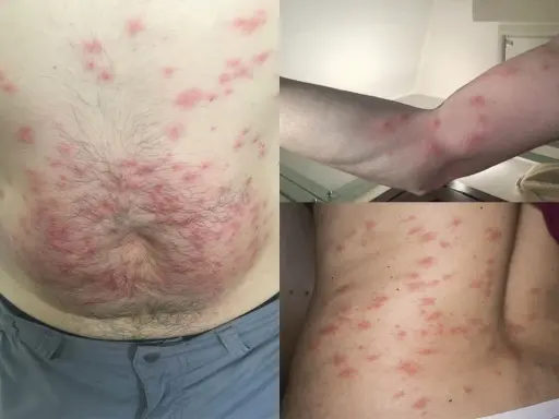 Punture di acaro su addome, braccio e schiena. Lesioni cutanee rosse e pruriginose diffuse.