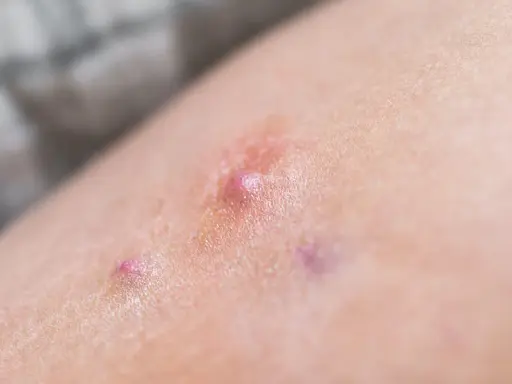 Pelle con arrossamento e piccole vescicole, indicative di dermatite bollosa.