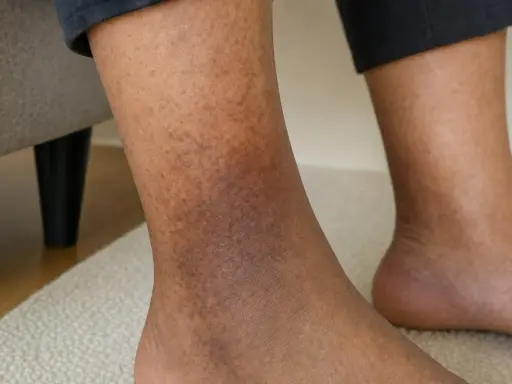 Gambe con macchie scure, segno di problemi di circolazione. La pelle presenta discromie evidenti nella zona della caviglia.