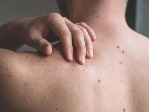 Una mano sfiora la schiena coperta di nei. Un neo irritato, forse dopo che ho grattato un neo ed è uscito sangue, attira l'attenzione.