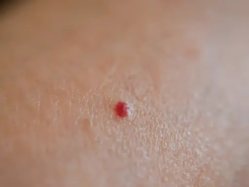 Piccola macchia rossa sulla pelle, un neo rubino che non prude.