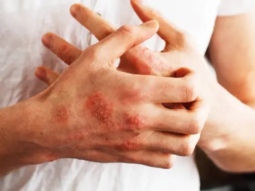 Mani con chiazze rosse e squamose, segno di psoriasi. Nonostante non sia mortale, la psoriasi può avere un impatto devastante sulla qualità della vita.
