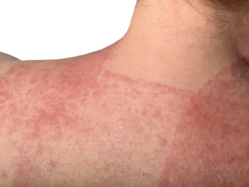 Pelle arrossata e irritata sulla spalla e sul collo, con chiazze evidenti. Potrebbe essere un caso di dermatite da incontinenza.