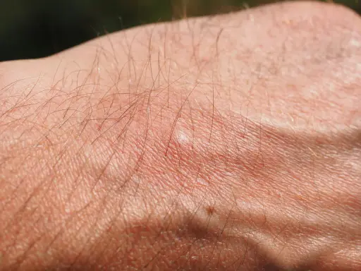Pelle secca e arrossata con peli sottili, possibile prurito senile. Il trattamento per la xerosi cutanea è fondamentale.