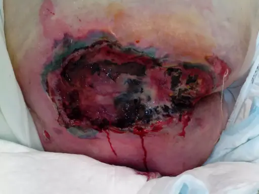 Grave lesione da decubito con tessuto necrotico e sanguinamento. La prevenzione piaghe da decubito è fondamentale per evitare queste condizioni.