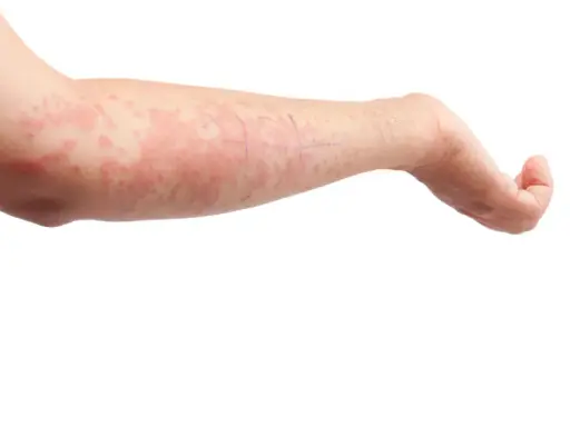 Braccio con eruzione cutanea rossa e pruriginosa, possibile reazione allergica o cause del prurito. Segni a matita sulla pelle.