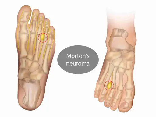 Illustrazione anatomica del piede che mostra un neuroma di Morton, una condizione che rende difficile camminare.