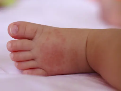 Piedino di neonato con piccoli puntini da sudore rossastri sulla pelle.