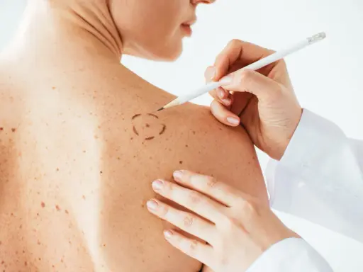 Medico disegna cerchio su neo per asportazione. La convalescenza dopo asportazione neo è un momento delicato.