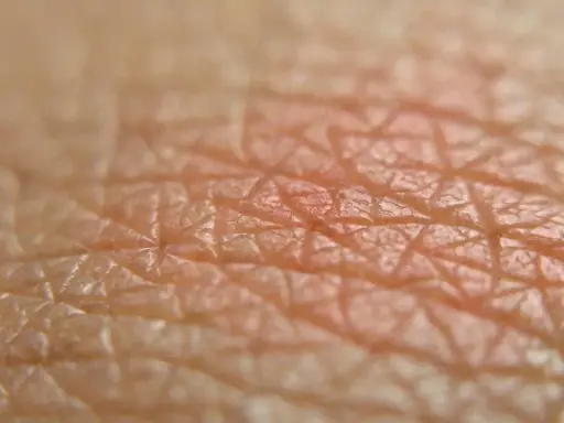 Close-up della pelle con arrossamento, suggerisce irritazione piega sedere rimedi.