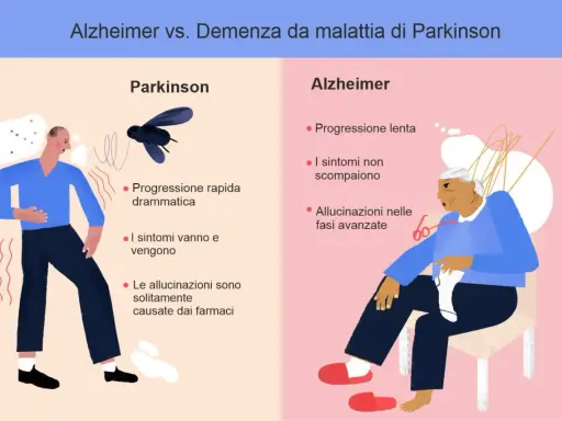 Confronto tra Parkinson e Alzheimer: progressione, sintomi e allucinazioni. Differenza tra parkinson e alzheimer illustrata con icone.