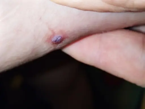 Una piccola piaga da decubito che sanguina, con un'area violacea al centro, su pelle chiara.