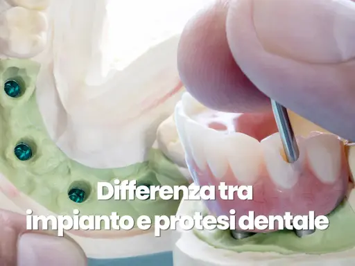 Modello dentale con impianti e protesi. L'igiene del cavo orale è fondamentale per la salute dei denti.