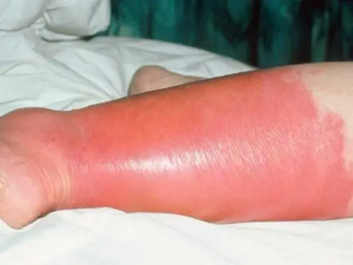 Gamba gonfia e arrossata, con segni di erisipela. La pelle appare lucida e tesa, con un'area di infiammazione estesa.