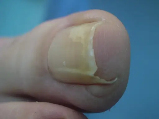 Dettaglio di un'unghia del piede con ispessimento e curvatura, che ricorda un'unghia a uncino.
