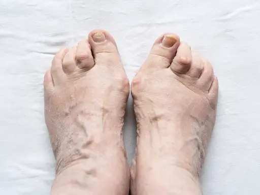 Piedi anziani con evidenti vene varicose e dita leggermente deformate, segno di piedi gonfi anziani.