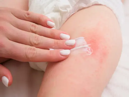 Mano applica crema su pelle arrossata, trattando una piaga da pannolino.