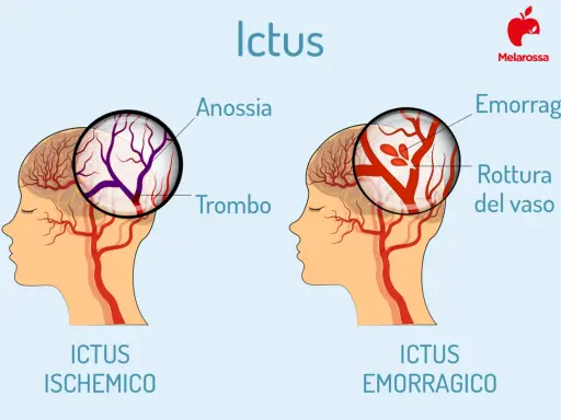 Ictus: confronto tra ischemico (trombo) ed emorragico (rottura vaso). L'emorragia cerebrale negli anziani è un rischio.
