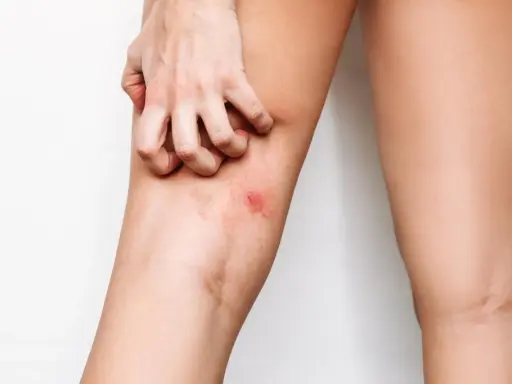 Mano che si gratta l'interno coscia con arrossamento. Possibili rimedi per l'irritazione interno coscia.