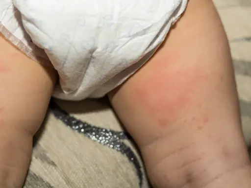 Pelle arrossata e irritata con piccole bollicine nella zona pannolino di un neonato.