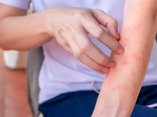 Braccio con pelle arrossata e puntini rossi, che indica la necessità di rimedi per l'irritazione cutanea.