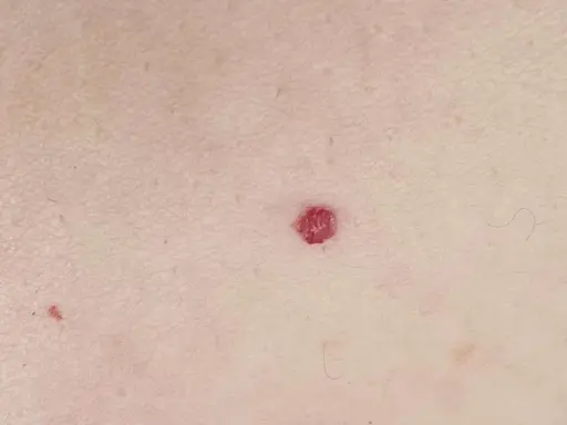 Una piccola macchia rossa sulla pelle, di forma quasi circolare, spicca sulla cute chiara.