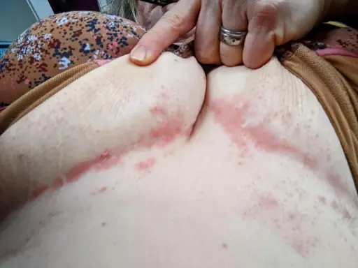 Pelle arrossata e irritata sotto il seno, con segni di piaghe da decubito. Una mano indica l'area interessata.