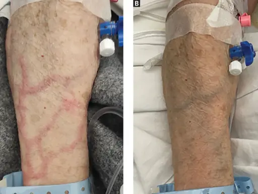 Braccio con segni di flebite, con vene rosse e gonfie in A, e un braccio più sano in B, con catetere venoso.
